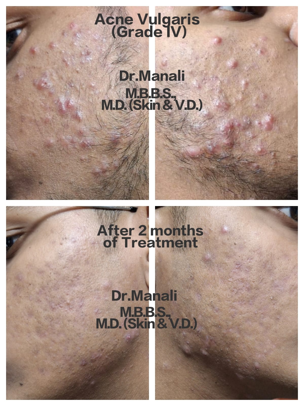 Acne Vulgaris Result