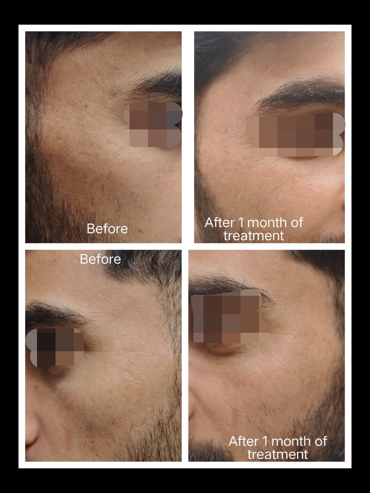 Melasma Result