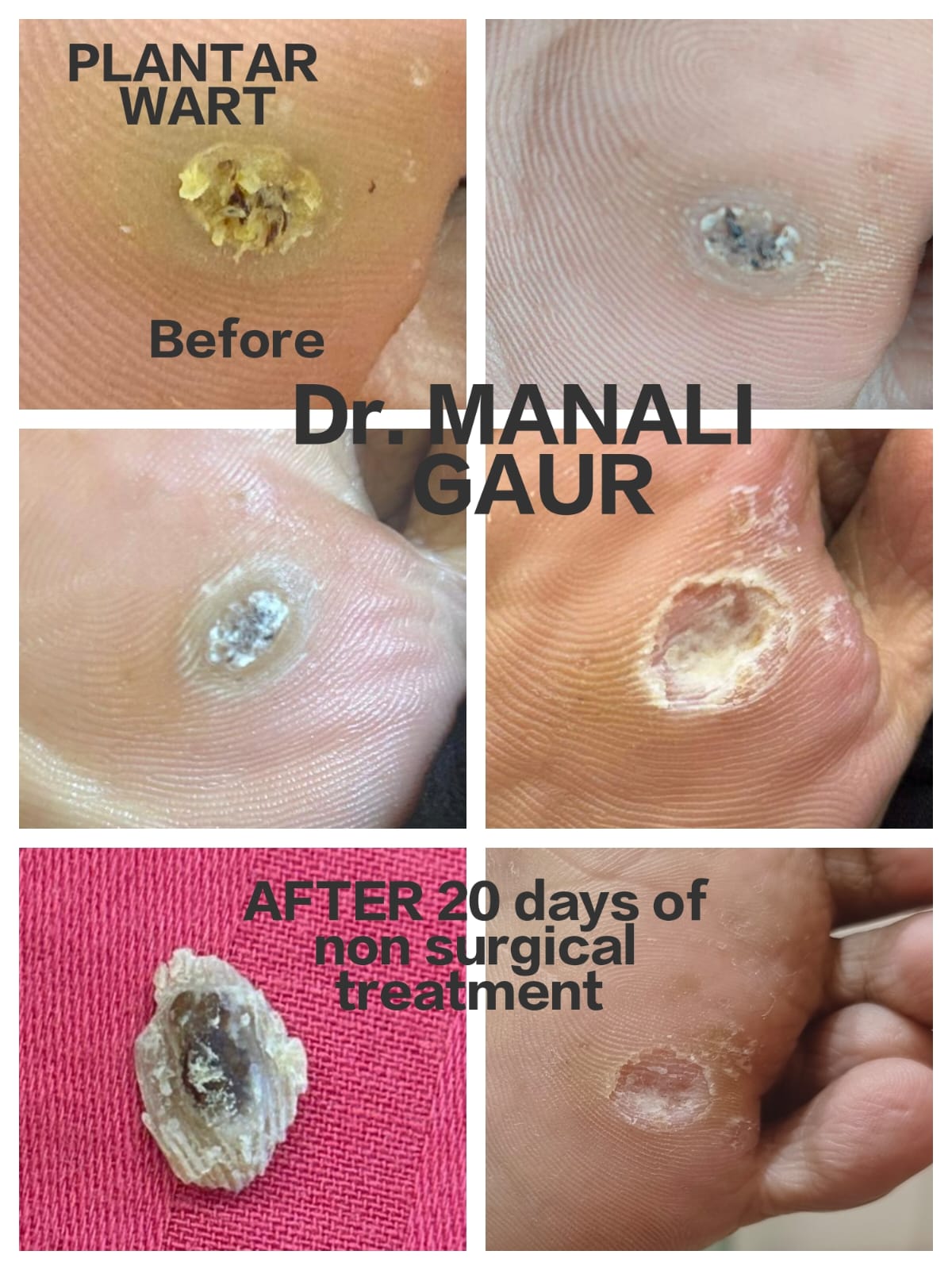 Plantar Wart Result