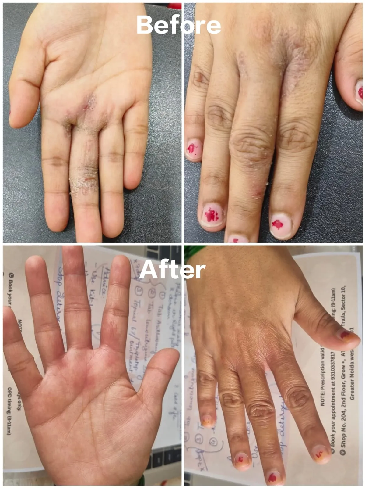 Psoriasis Result