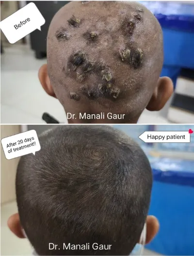 clinical hair fall treatment results by dermatologist Dr Manali Gaur