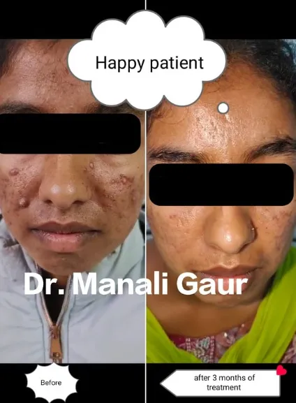 Acne treatment results by dermatologist Dr Manali Gaur