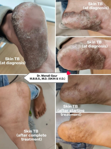 Skin infection treatment results Greater Noida