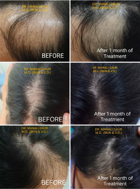 Alopecia Areata Result