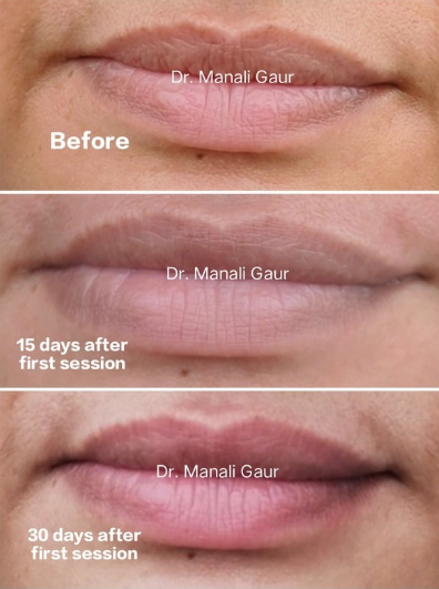 Lip Pigmentation Result