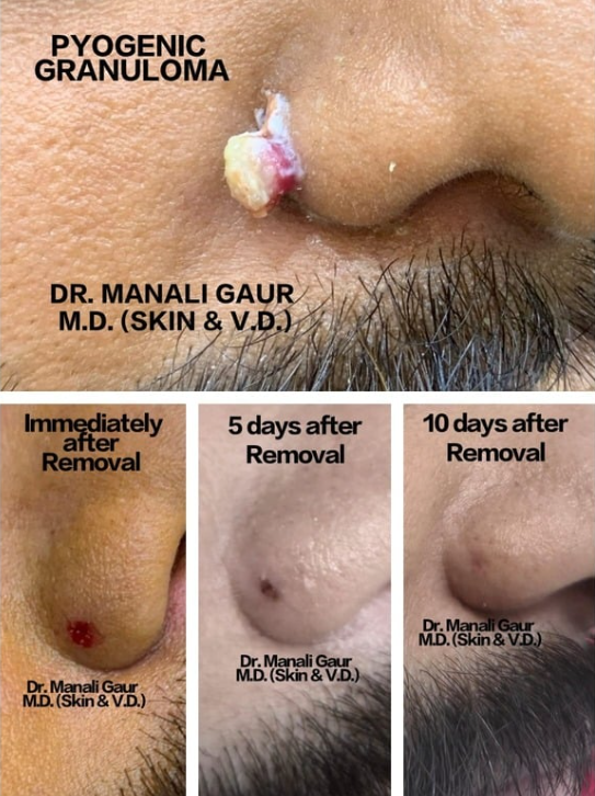 Pyogenic Granuloma Removal Result