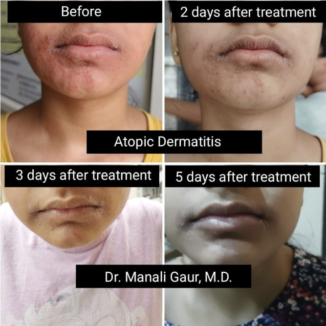 Atopic Dermatitis Result