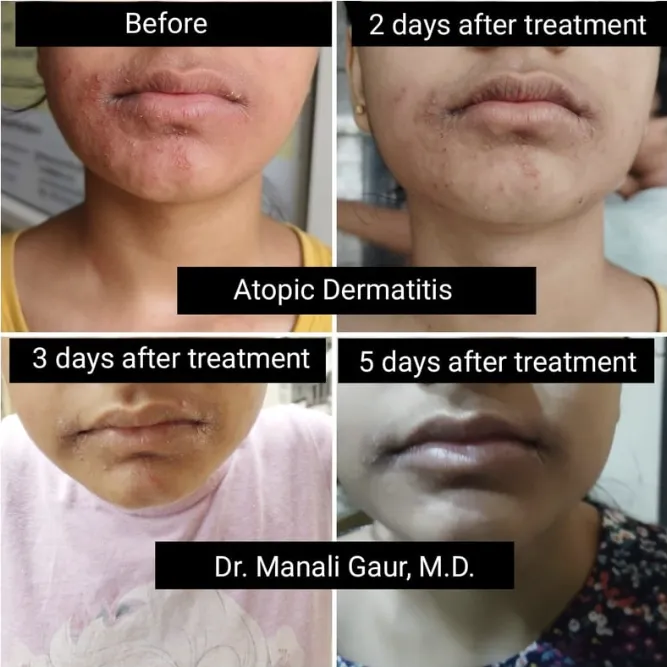 Atopic Dermatitis Result