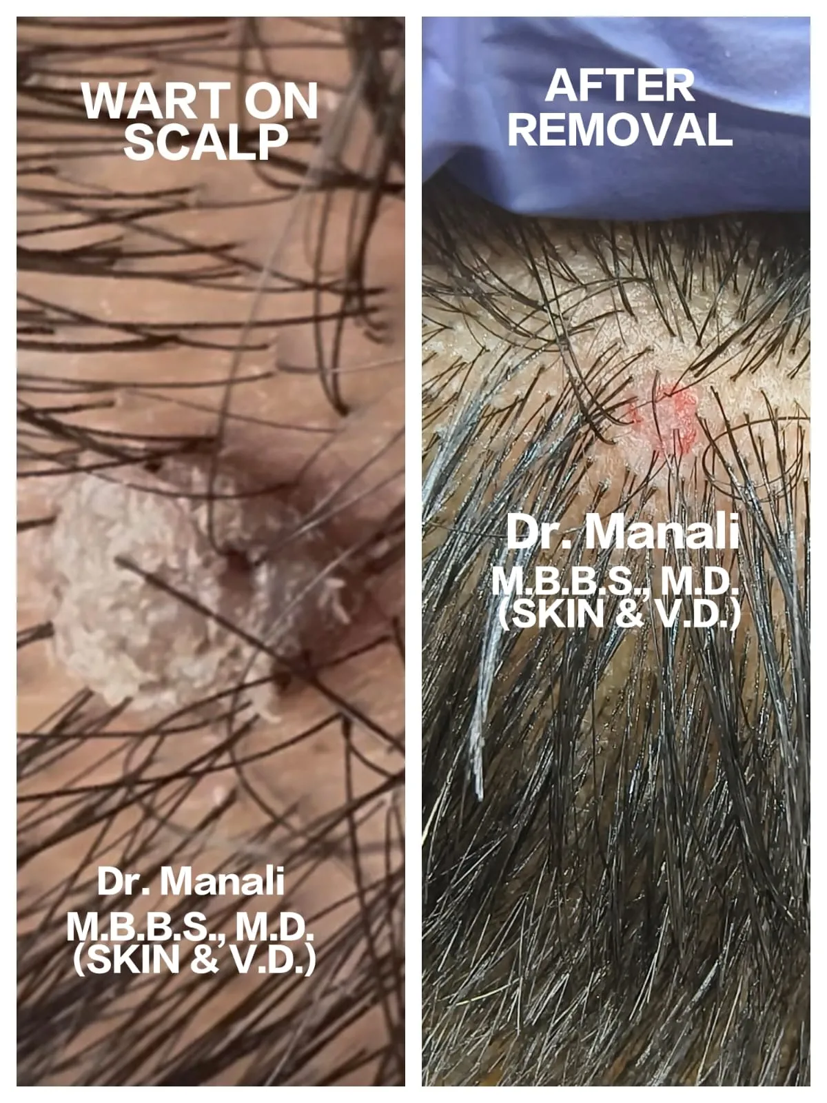 Scalp Wart Result