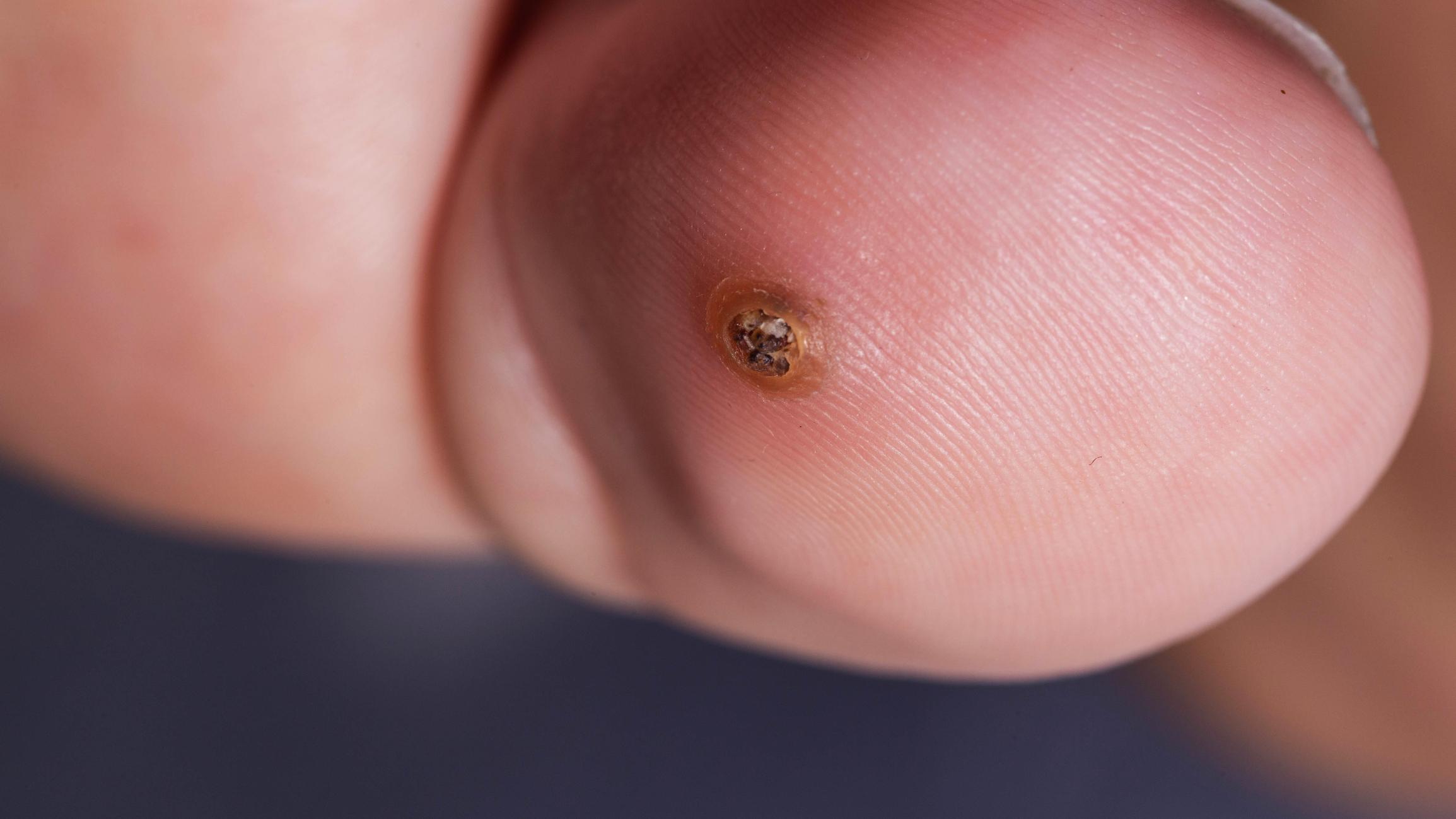 Wart Removal Treatment