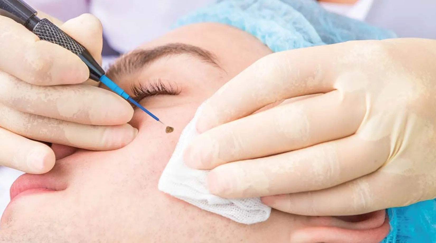 Electrosurgery Treatment