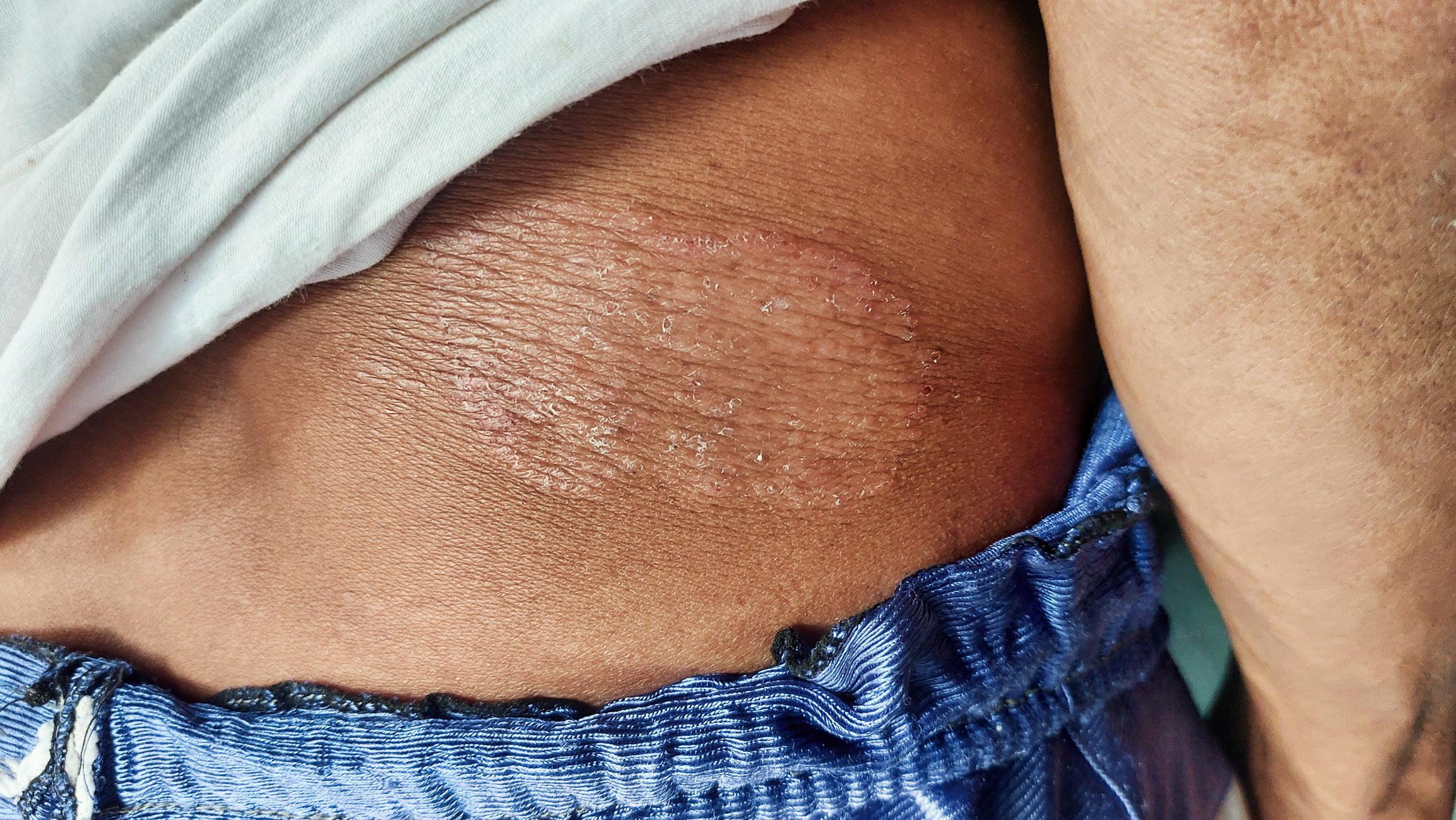 Fungal Infection Treatment