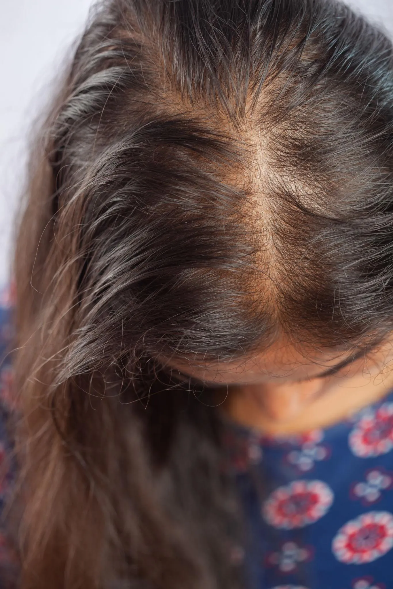 Alopecia Areata