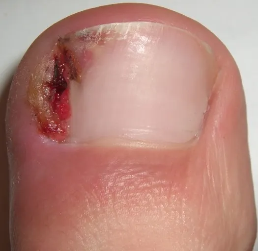 Ingrown Nail Surgery