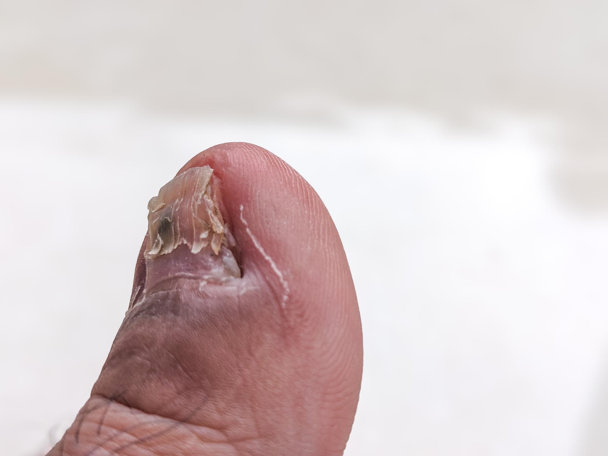 Nail Disorders Treatment