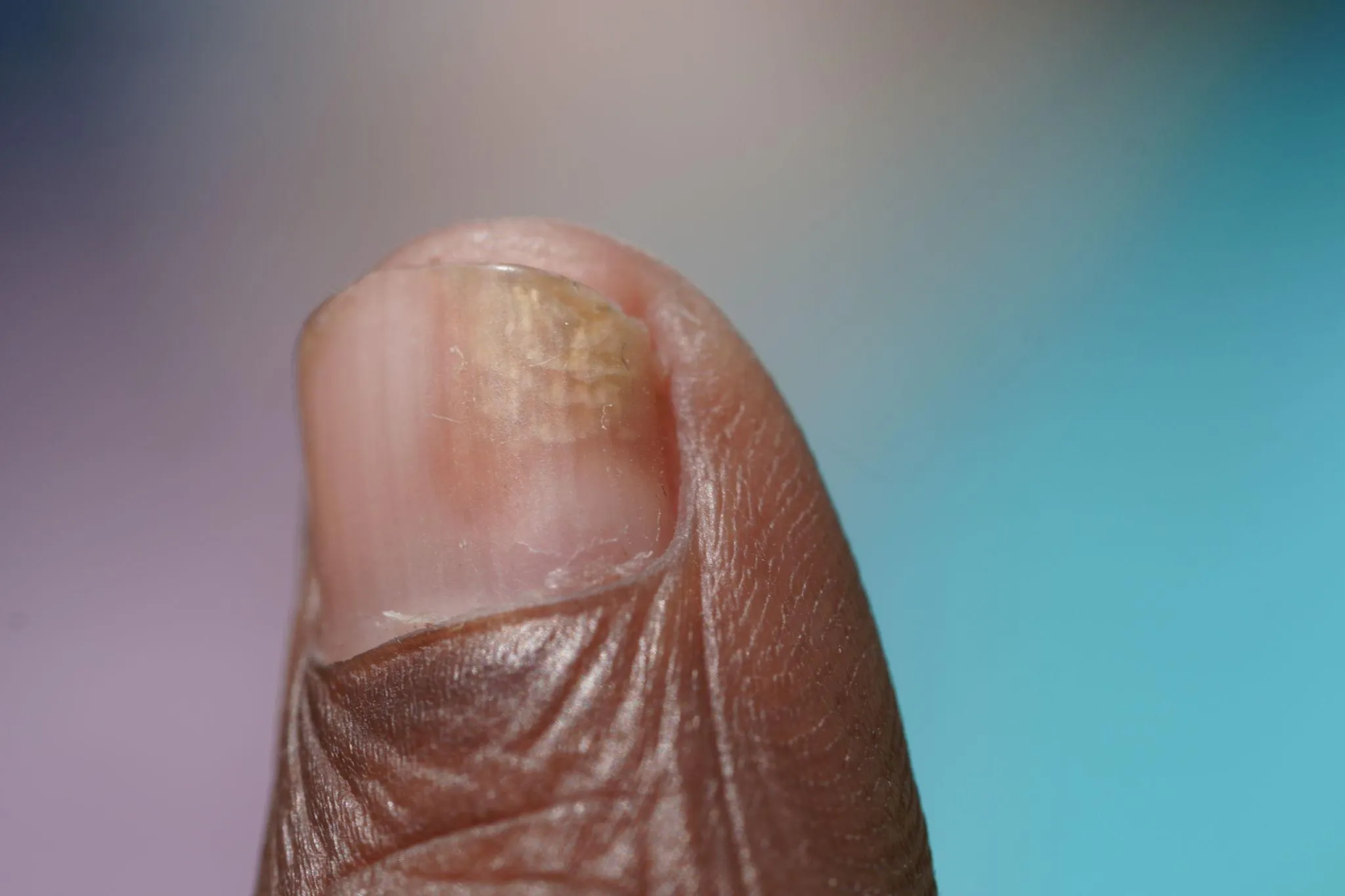 Nail Disorders Treatment