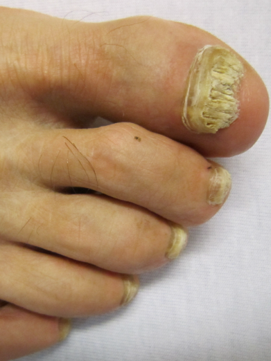 Fungal Nail Care