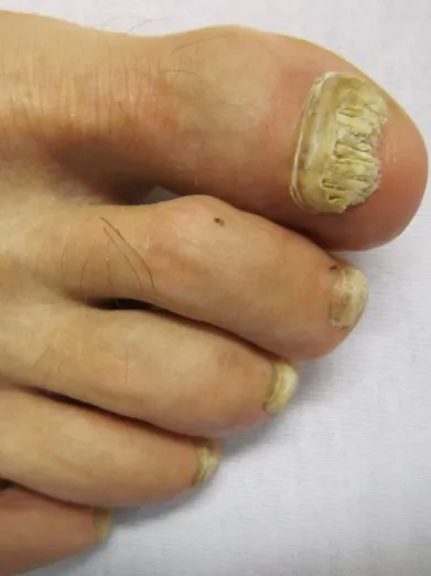 Fungal Infections