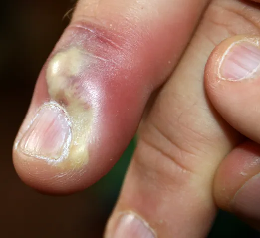 Paronychia Control