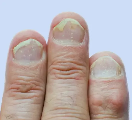Nail Psoriasis
