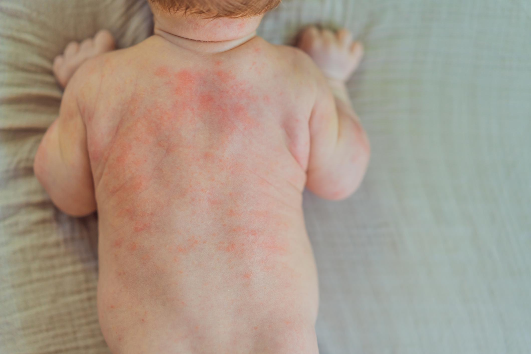 Pediatric Dermatology