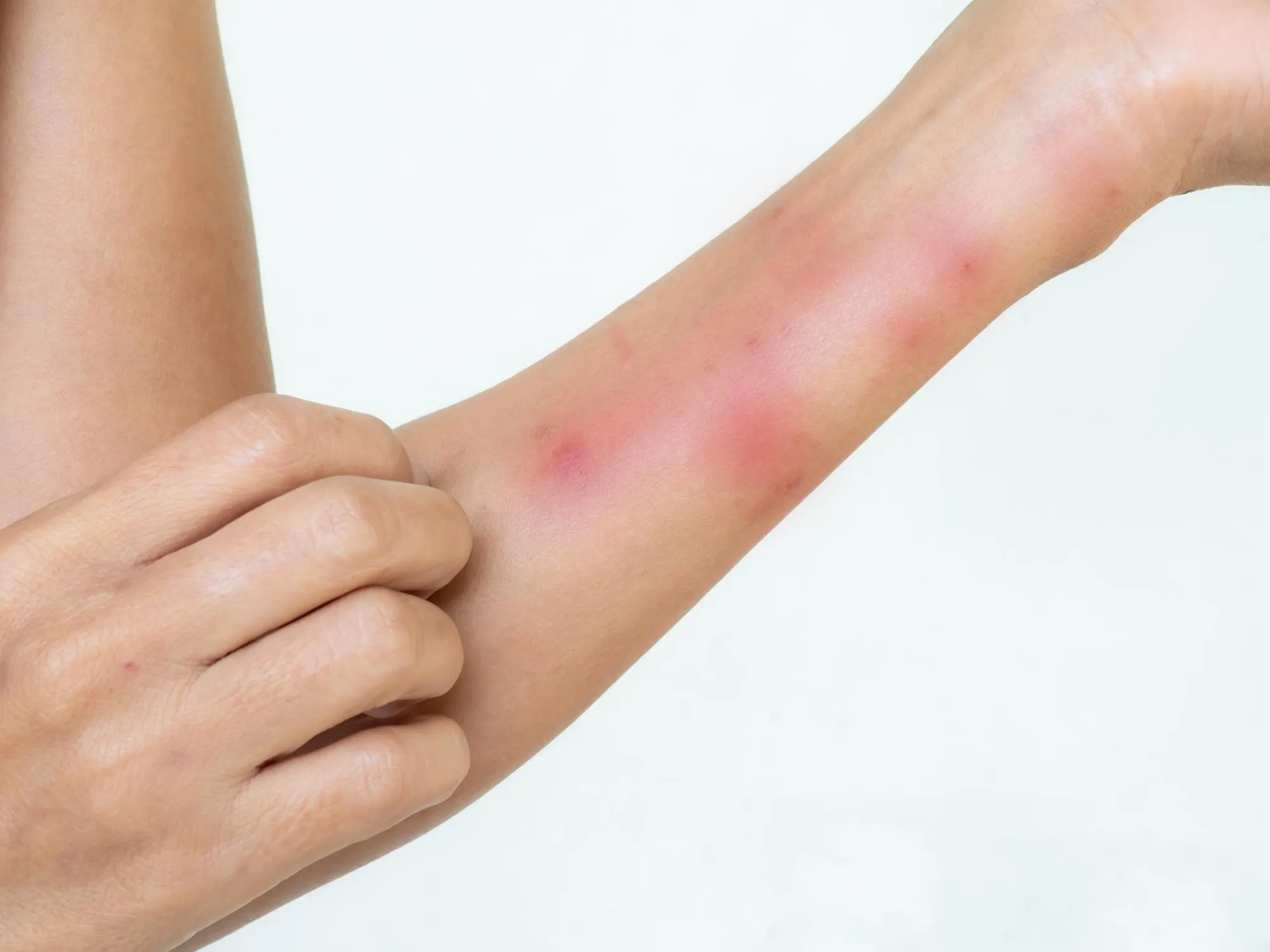 Skin Allergy Treatment