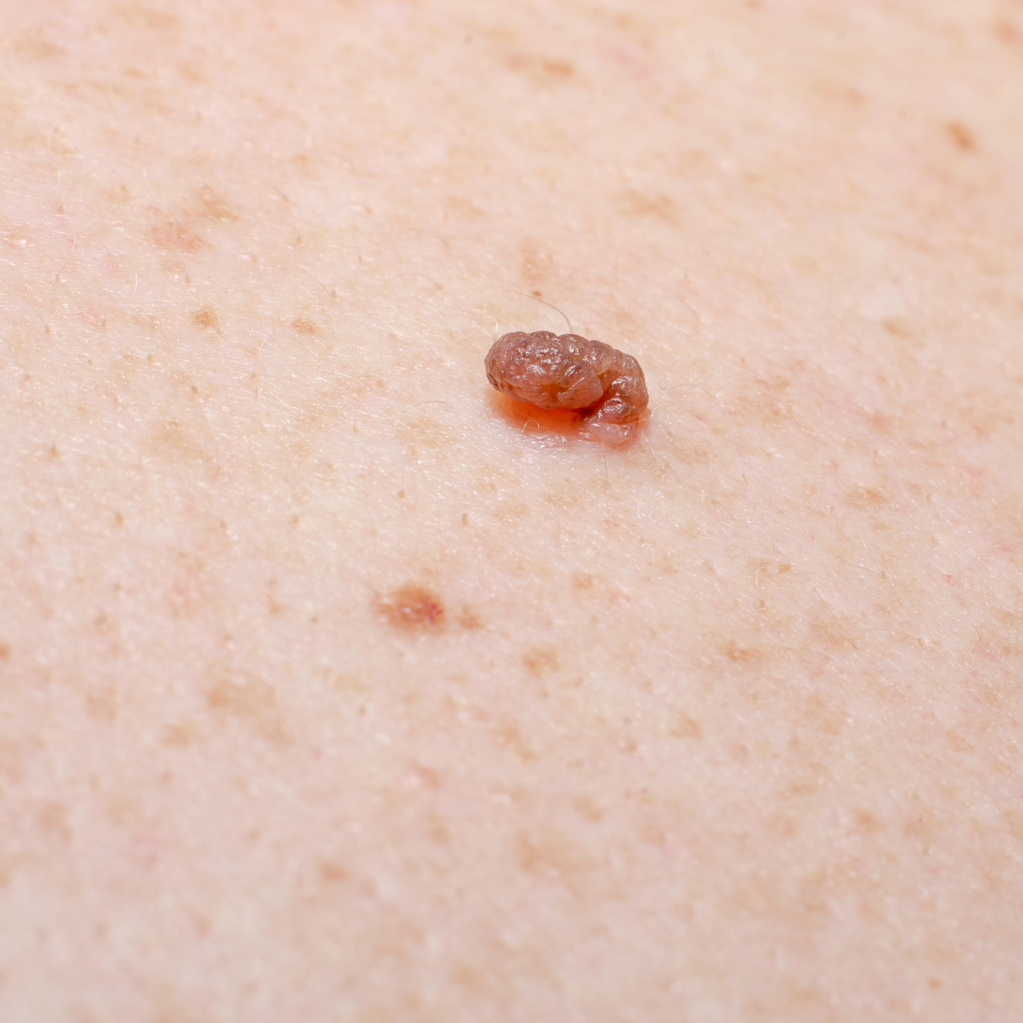 Skin Tag Removal