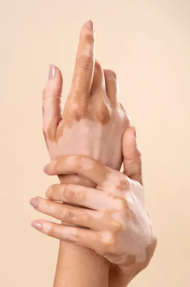 Vitiligo Treatment